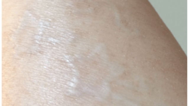 4 Laser Tattoo Removal Myths