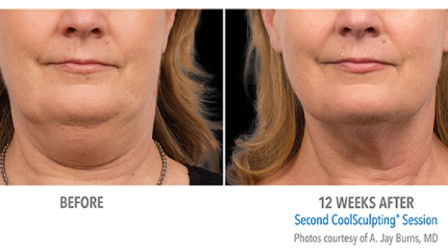 Frosty Fat to Fab: Unveiling the Magic of CoolSculpting!