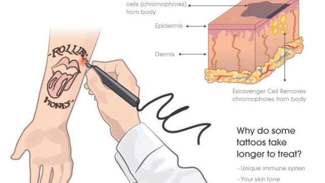 Gang Tattoo Removal – When You Will Not Want Gang Associations