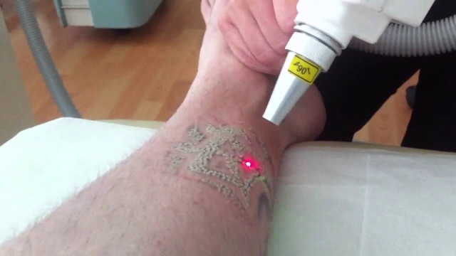 Bad Ink – Recognizing When It’s The Perfect Time For Laser Tattoo Removal