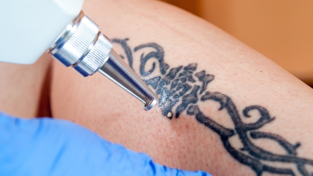 Choices And Methods For Tattoo Removal