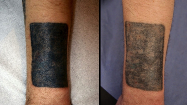 The Associated With Tattoo Removal: Read This And May Well Avoid Money