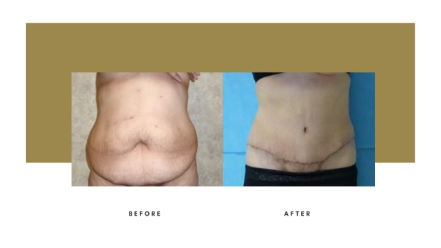 Tighten and Tone: Unveiling the Secrets of a Sensational Tummy Tuck