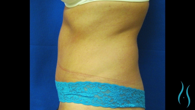 Tummy Tuck: Sculpting a Flatter, Beautiful Abdomen