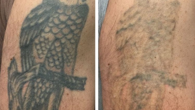 Tattoo Removal Expectations