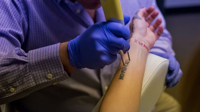 The Price Tattoo Removal: Read This And Avoid Money