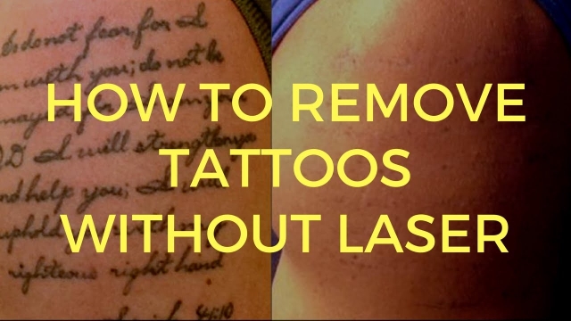 Everything About Tattoo Removal
