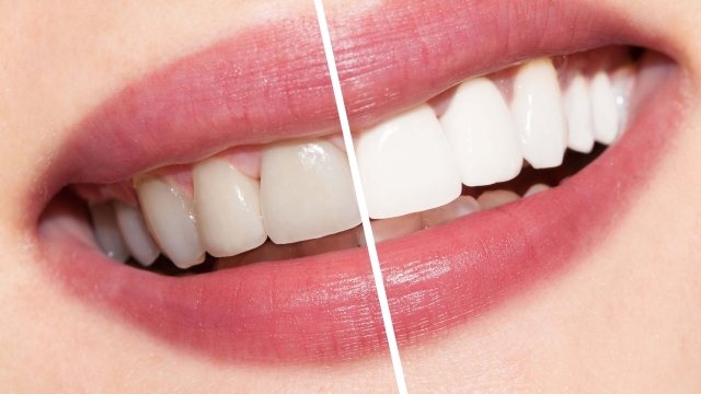 Sparkling Smiles: Unveiling the Secrets to Pearly Whites with Teeth Whitening Products