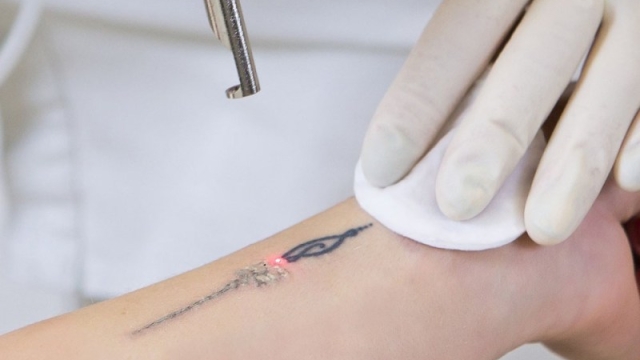 Tattoo Removal Creams – Solve Your Tattoo Problem Without The Pain