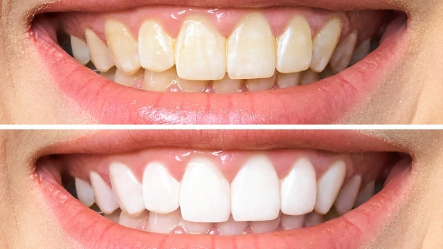 Unveiling the Luminous Smile: A Guide to Crest Whitening Strips